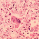 Above, an image of pneumonia (lung inflammation) caused by the measles virus.